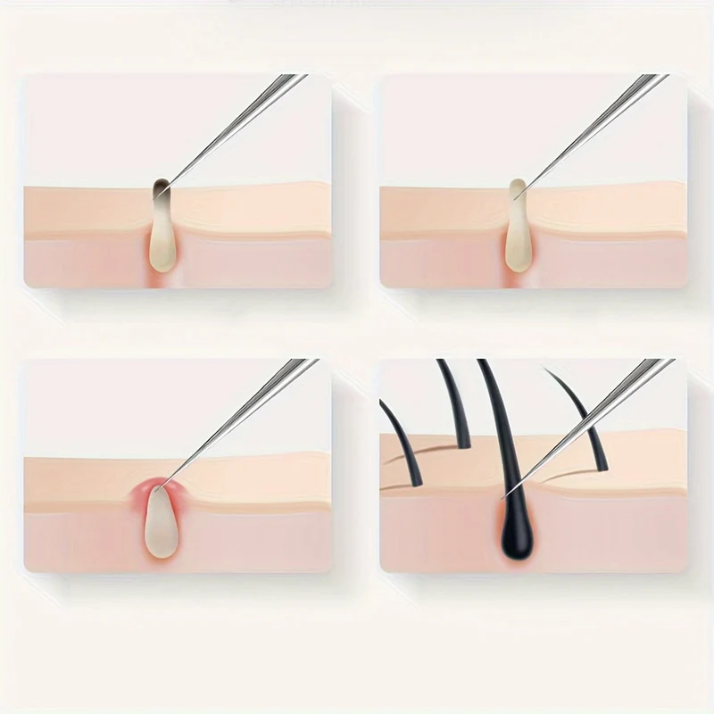 Euroselle Odorless Stainless Steel Blackhead And Whitehead Extractor For Face And Nose